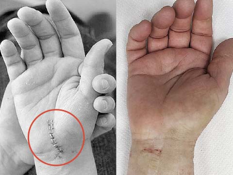 Cicatrici a confronto: intervento tradizionale sul palmo, intervento endoscopico sul polso