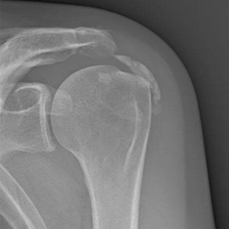 Radiografia di una calcificazione di spalla
