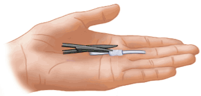 Intervento chirurgico dito a scatto: apertura della puleggia A1