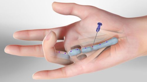 Morbo di Dupuytren, trattamento percutaneo con ago