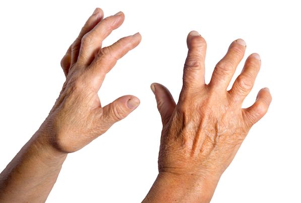 Artrosi alle mani