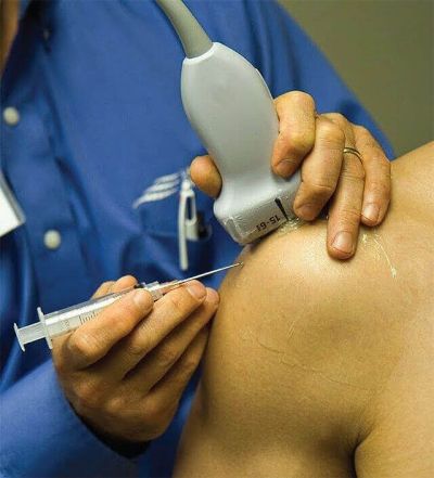 Calcificazione alla spalla, litoclasia eco-guidata