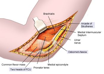 Sindrome del tunnel cubitale: intervento chirurgico