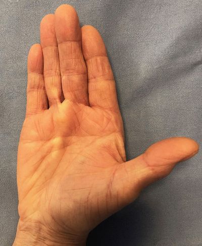 Malattia di Dupuytren, noduli