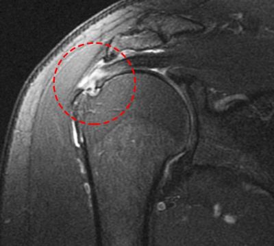 Risonanza magnetica di una lesione della cuffia dei rotatori
