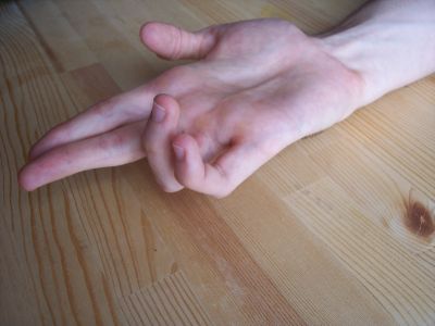 Sindrome del tunnel cubitale: mano ad artiglio