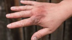 Ustione alla mano: cosa fare
